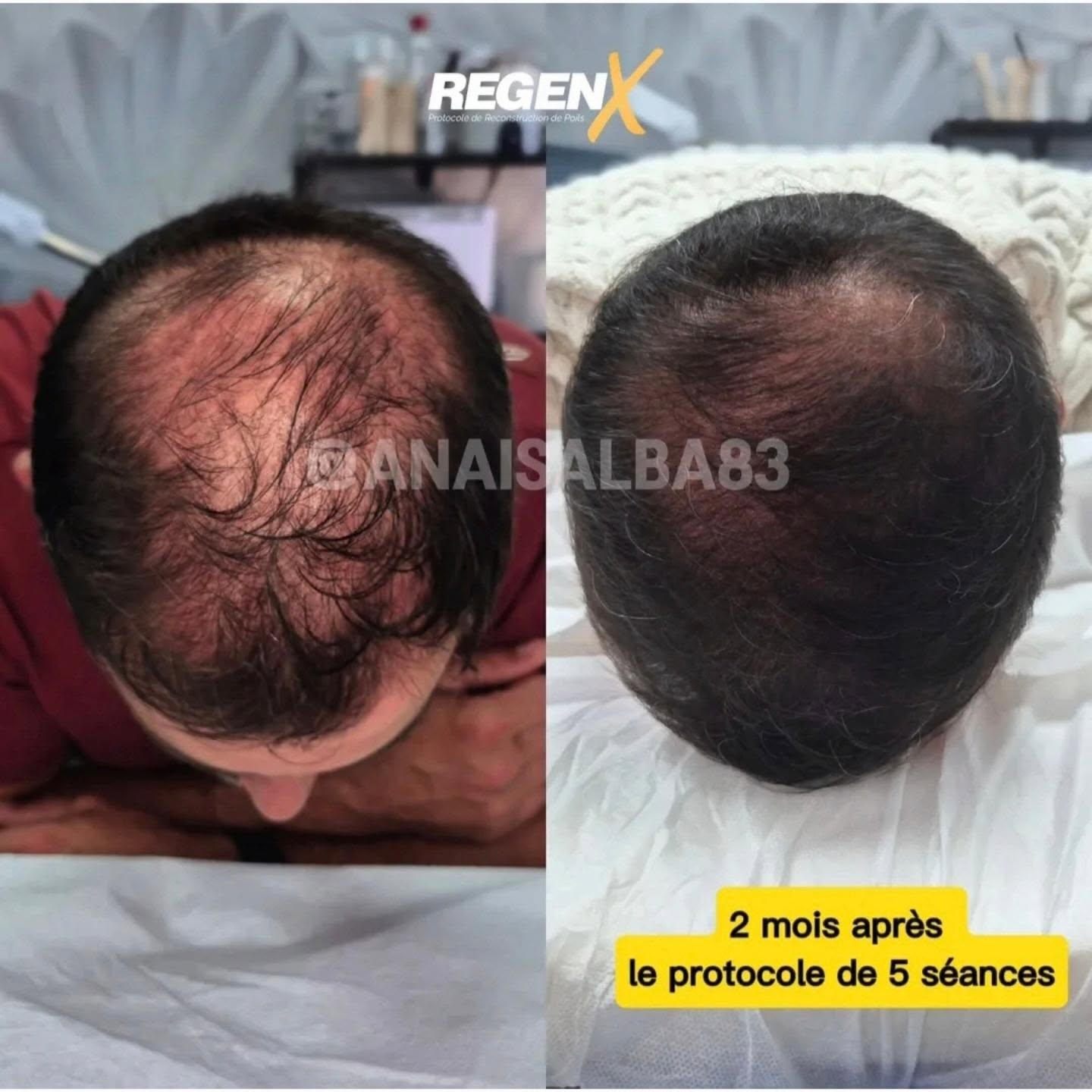 Comparaison de densité capillaire présentée sur le visuel REGEN X fourni